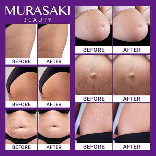 Stretch Mark Cream Prevention for Pregnancy - Maternity Cream for Stretch Marks Removal | Nourishing Formula ? Prevents Stretch Marks & Improves Elasticity - 4 oz (120g) (4 oz (120g))