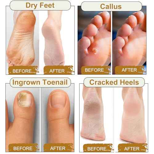 10Pack Foot Soak with Epsom Salt, Epsom Salts for Soaking,Dead Sea Salt Soothes Tired Feet, Odor Scent, Spa Pedicure Care Foot Soaking, with feet scrubber