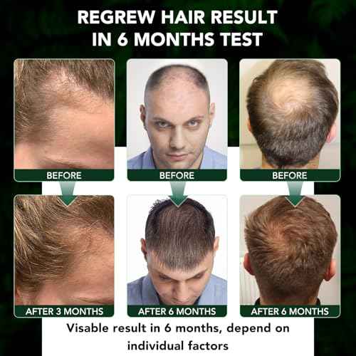 Minoxidil for Men and Women Hair Growth Spray, 5% Minoxidil Beard Growth Oil, Advanced Hair Regrowth Serum Topical Solution Spray Treatment for Hair Loss, Thinning, Hair Regrowth & Thicker 2.02 fl.oz
