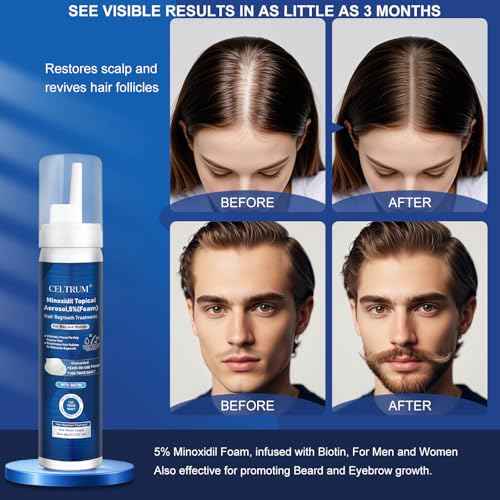 5% Topical Minoxidil Foam, Minoxidil for Men and Women, Infused with Biotin, Hair Growth Treatment, Supports Thicker and Fuller Hair & Beard (Minoxidil Foam, 8.44oz, 4 Month Supply)