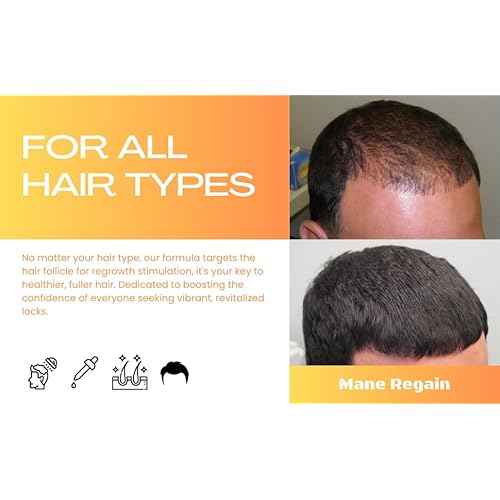 Minoxidil Topical Solution USP 5%, Extra Strength Hair Regrowth Treatment for Men, 2 Month Supply, Unscented, 4 Fl Oz (2 Pack)