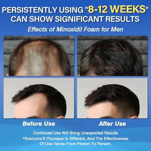 Minoxidil 5% Foam for Men Hair Growth Foam Suitable for Hair Thinning Receding Hairline and Hair Loss to Hair Regrowth Get Thicker Fuller Hair 3 Bottles 2.11 Ounces Each