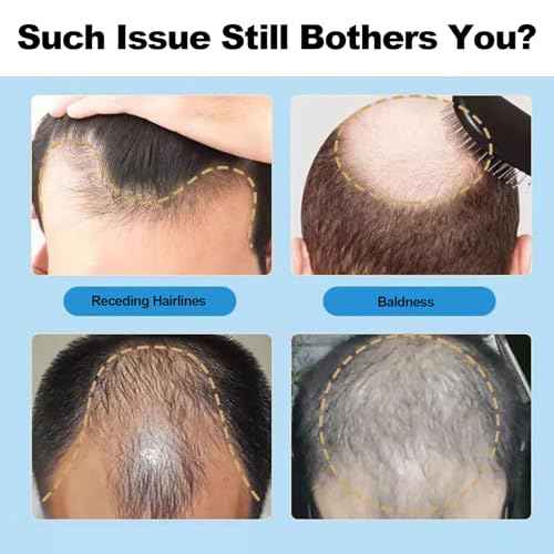 5% Minoxidil for Men Hair, Minoxidil Hair Growth Serum for Women Hair Growth, Men Beard Growth, Hair Loss Treatment with Dropper Applicator & Massage Tool