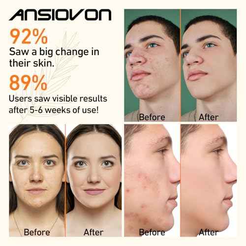 Blue Light Therapy Device for Acne Spot Treatment - LED Acne Blue Light Therapy Wand for Face