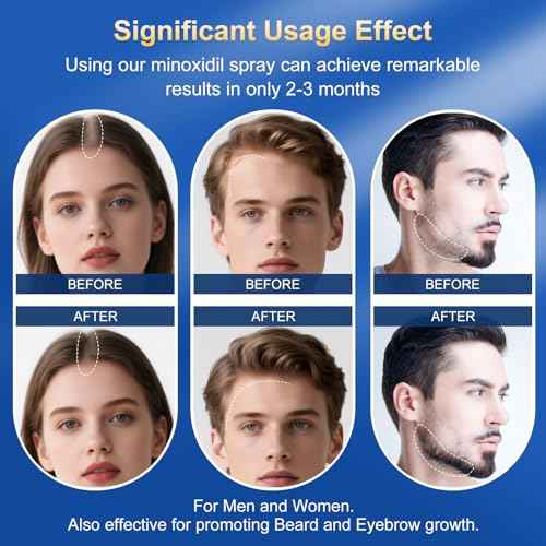 5% Minoxidil Spray for Men & Women - Hair Growth Serum & Hair Regrowth Treatment | Extra Strength with Biotin | 12-Month Supply 8-Pack (28 fl oz) | Clinically Proven for Hair Loss & beard growth