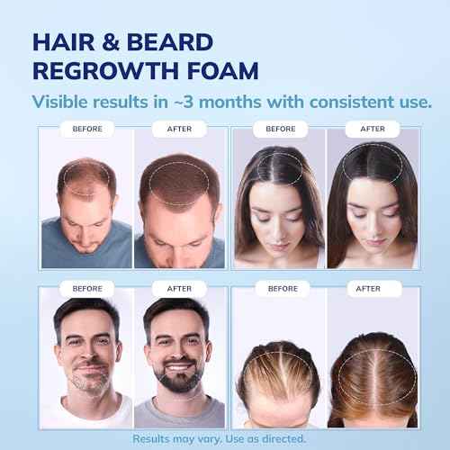 5% Minoxidil Foam for men and women, Extra Strength Hair Regrowth Treatment for Thinning Hair and Hair Loss, Hair Follicle Health ? Thicker, Fuller Hair Growth Solution 6 FL.OZ