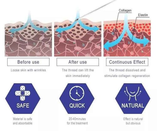 Oldream Pcl Cog Threads, Pcl Fishbone Threads 18G100mm, Pcl Threads for Face, Age-Defying Lift, Bullet Model, 20Pcs