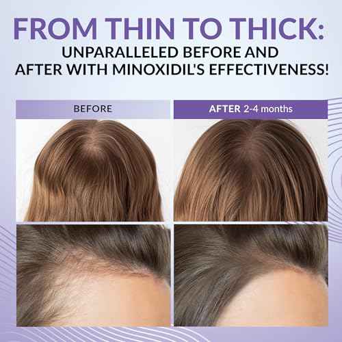 Minoxidil for Women 2% - Hair Growth Serum Women + Vitamin E, Ginseng, Ginger Extract, Biotin Hair Growth Serum - Hair Loss Regrowth & Thickening Treatment Helper