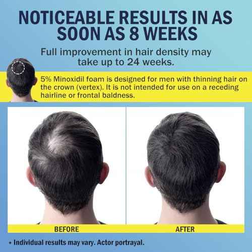 5% Minoxidil Foam for Hair Regrowth, Topical Hair Loss Treatment for Men to Regrow Fuller, Thicker Hair, Rosemary Minoxidil Topical Aerosol, 60ml / 2.11oz