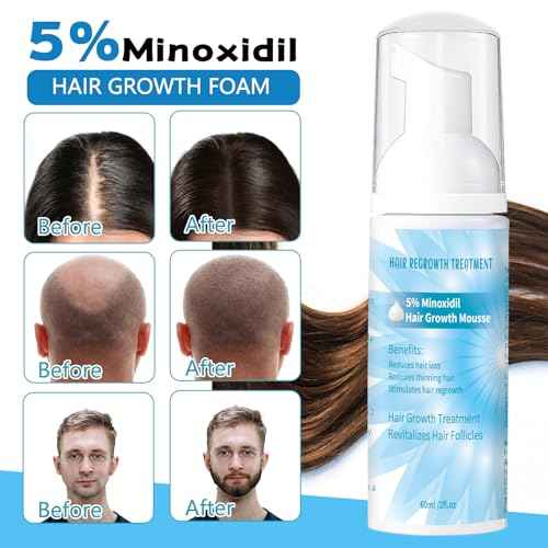 5% Minoxidil Foam for Men, Minoxidil for Women Hair Growth, Infused with Biotin, Hair Growth Treatment, Foam Hair Regrowth Treatment for Hair Thinning Receding Hairline,(2 oz Bottle), 3-Pack