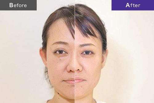 b.glen Once daily tightening & lifting massage serum for a contoured complexion featuring peptides and botanical extracts 【b.glen QuSome Lift (60g/2.12oz)】