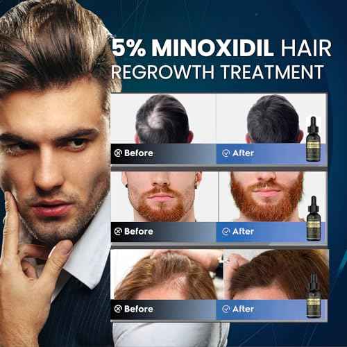 5% Minoxidil Hair Growth for Men and Women: Biotin Hair Growth Serum for Hair Loss, Thinning, and Faster Regrowth Treatment - 60ML