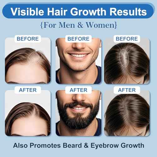 5% Minoxidil Foam with Biotin ? Hair & Beard Growth Treatment for Men & Women, Fragrance-Free, Non-Greasy, 4-Month Supply (8.44oz), Clinically Trusted Formula ERYLVEKA