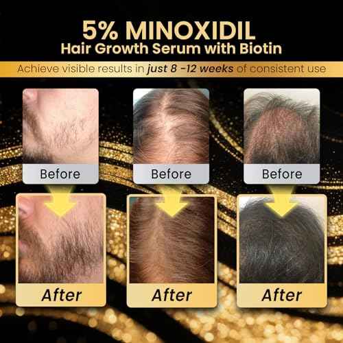 5% Minoxidil Hair Growth for Men and Women, Extra Strength Minoxidil Hair Loss Treatment Serum with Biotin for Faster Stronger Thicker Hair Growth 60ML - For Women Hair, Men Hair & Beard Growth