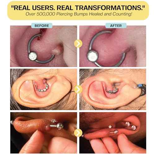 BASE LABORATORIES Keloid Bump Removal Gel | Natural Piercing Bump Treatment & Keloid Scar Gel | Keloid Scar Removal for all Scars, Keloids & Piercing Bumps | Soothing Piercing Aftercare | 2 oz