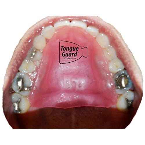 RPE Tongue Guard: Prevents and Helps Heal Tongue Sores Caused by Dental Expanders