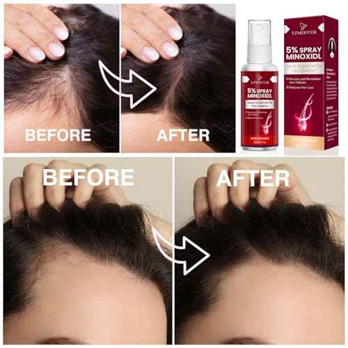 5% Minoxidil for Women Hair Growth: Hair Loss Treatment for Hair Thinning and Hair Loss to Get Thicker and Fuller Hair, 60ML