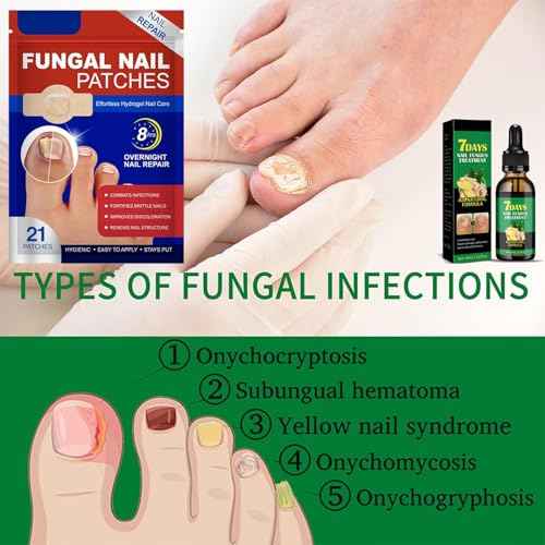 Fungal Nail Patches & Ginger 7 Days Nail Treatment ? Daily Nail Support for Stronger, Clearer Looking Nails ? Easy-to-Use Hydrogel Patches + Natural Formula, 21 Patches & 30ml
