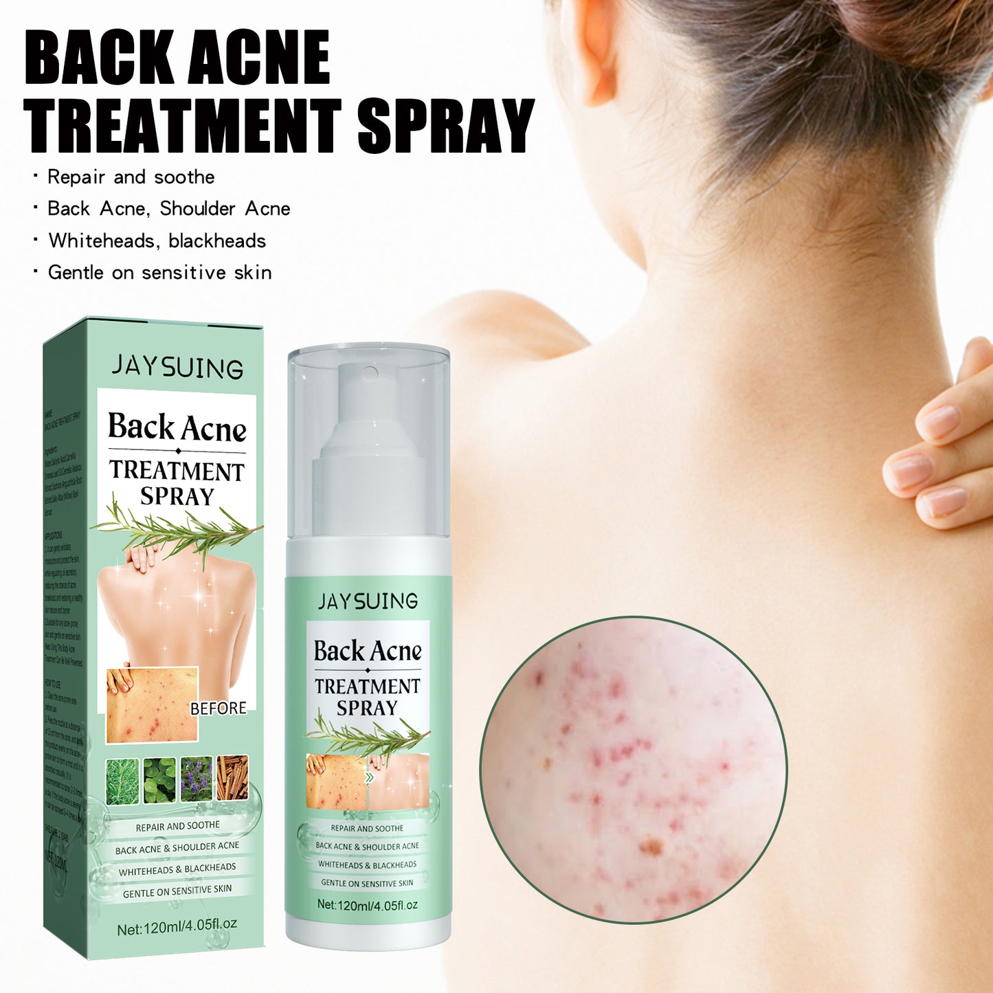 Back Acne Repair Treatment Spray - Salicylic Acid Body Acne Clearing Mist
