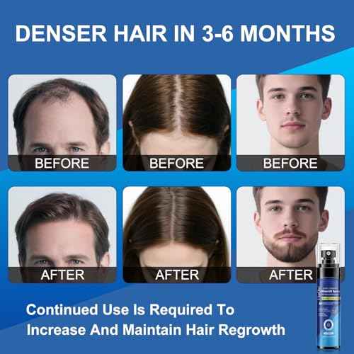 5% Minoxidil Spray for Men and Women, Infused with Biotin, for Hair Regrowth Treatment, Beard Growth, Extra Strength Treatment to Combat Hair Loss and Thinning, 5 Month Supply, 3 x 3.38 oz