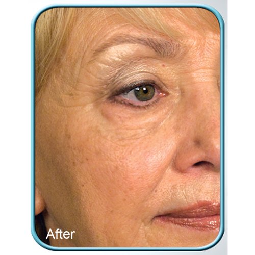 Stem Cell Therapy 3-pack