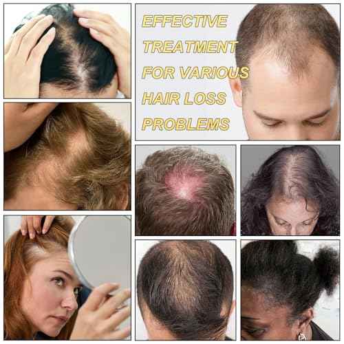 5% Minoxidil for Men and Women Hair Growth Serum, Biotin Hair Growth, Hair Regrowth Treatment for Scalp Hair Loss Hair Thinning for Thicker Longer Fuller Healthier Hair (Pack of 1)