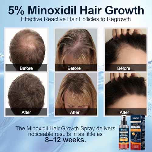 Minoxidil Spray, 5% Minoxidil for Men Hair Growth Serum, Minoxidil for Women Hair Growth Products, Hair Regrowth Treatment for Help to Stop Thinning and Loss Hair, Formula Light and non Greasy 100ML