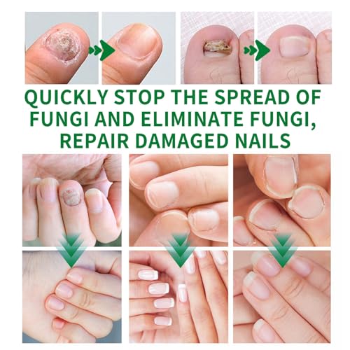 3Pcs Ginger Nail Treatment, 7days Nail Growth Serum Solution, Ginger Cuticle Care Oil for Nails Strengthener, Promote Nail Healthy Grow(30ml)