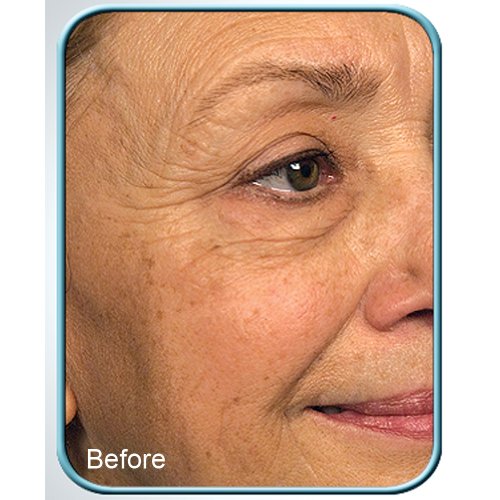 Stem Cell Therapy 3-pack