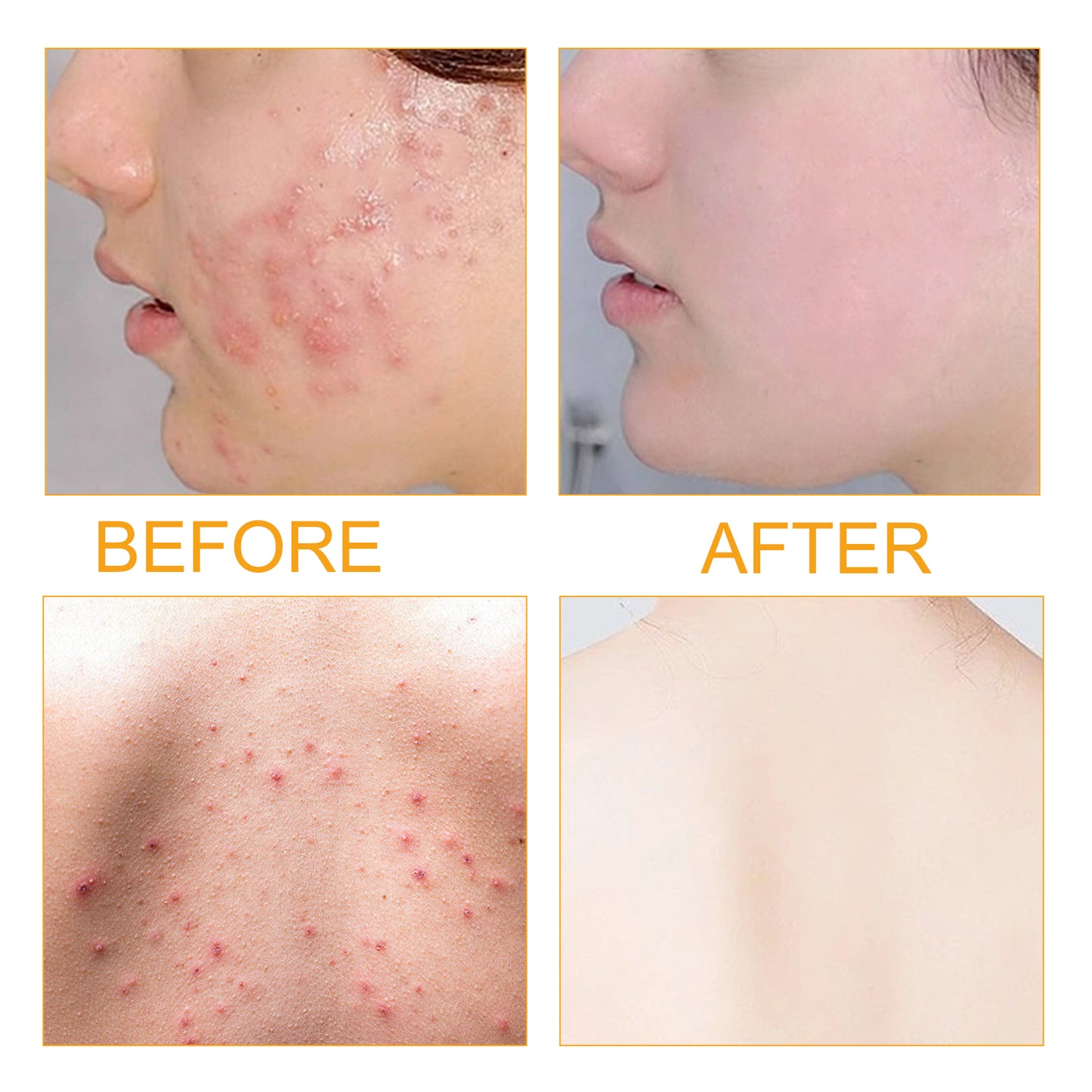 Anti-Acne Body Serum with Collagen Peptide - 50ml Pore Refining Treatment