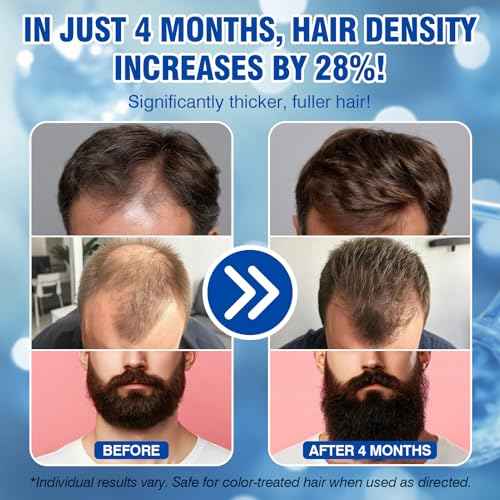5% Minoxidil for Men Hair Growth Spray Serum Topical Minoxidil Beard Hair Regrowth Thicker Prevent Hair Loss for Thicker Longer Fuller Healthier Hair 3 Bottles of 2oz