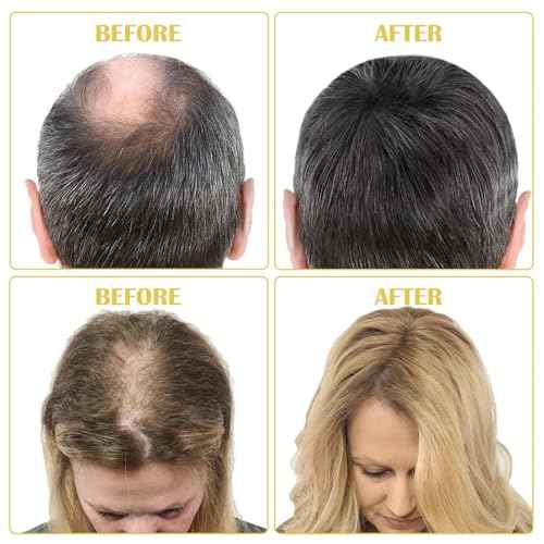 5% Minoxidil for Men and Women Hair Growth Oil, Minoxidil Hair Growth Serum Infused with Biotin for Hair Regrowth Treatment, Scalp Hair Loss Hair Thinning, Natural Hair Growth 2.02 oz