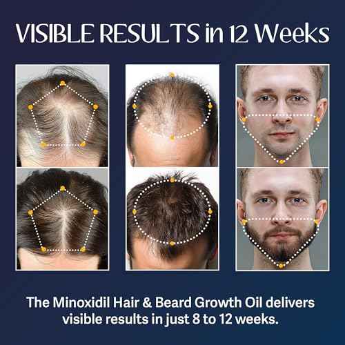 5% Minoxidil for Men Beard Growth Kit: Venanoci Hair Regrowth Oil with Biotin & Rosemary ? Thicker, Fuller Beard & Hair ? Stop Hair Loss & Thinning ? Hair Growth Serum Treatment