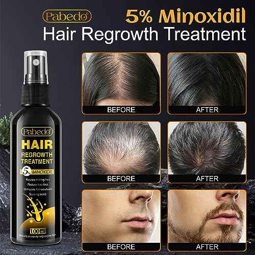 5% Minoxidil Hair Growth Serum, Minoxidil Spray For Beard Growth Serum, Hair Growth oil Spray, Treating Hair Loss For Thicker Longer Fuller Healthier Hair, 3.38 Oz
