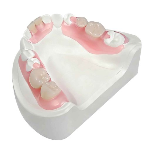 Partial Dentures - Custom Removable Personalized Tooth Replacement Set for Missing Teeth & Gap (1 Tooth)