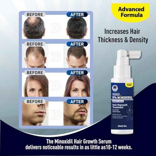 Minoxidil for Men 5% Minoxidil for Women Hair Growth, Hair Regrowth for Men Minoxidil 5 Percent for Thin Hair, Hair Loss Treatment to Regrow Fuller Thicker Hair, 2 Month Supply(2 bottle 2 oz)