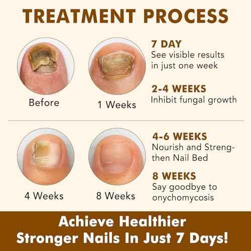 Ginger Nail Treatment, Nail Growth Serum, Nail Repair & Strengthening Oil, Ginger Cuticle Care Oil, Deep Hydration & Nourishing Support for Healthy Nails, 30ml, 2PCS