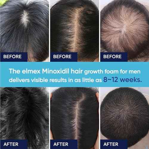 5% Minoxidil Foam for Men and Women, Minoxidil for Men Foam for Hair and Beard, Minoxidil for Women Hair Growth (2 Ounce)