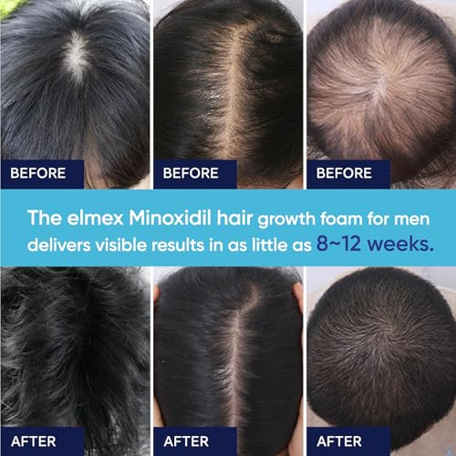 5% Minoxidil Foam for Men and Women, Minoxidil for Men Foam for Hair and Beard, Minoxidil for Women Hair Growth (6 Ounce)