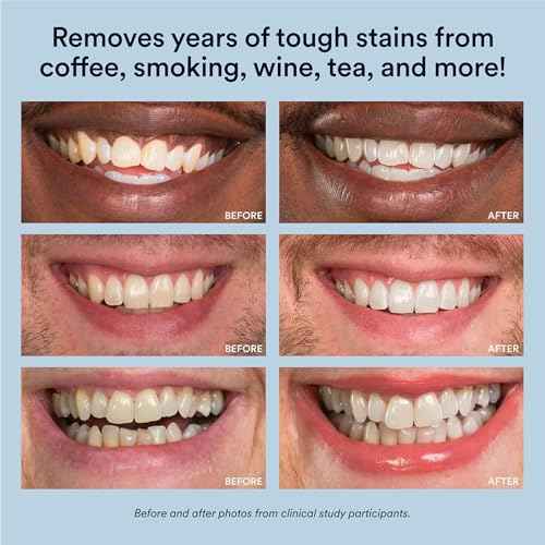 Auraglow Teeth Whitening Kit, LED Accelerator Light, 35% Carbamide Peroxide Teeth Whitening Gel, 20+ Whitening Treatments, Whitens up to 10 Shades in 7 Days