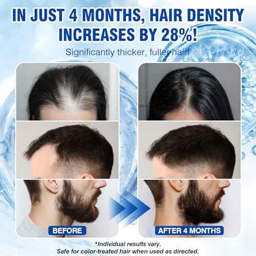 5% Minoxidil for Men and Women Hair Growth Spray Serum Minoxidil Biotin for Hair Beard Growth Prevent Hair Loss for Thicker Longer Fuller Healthier Hair 3 Bottles of 2oz