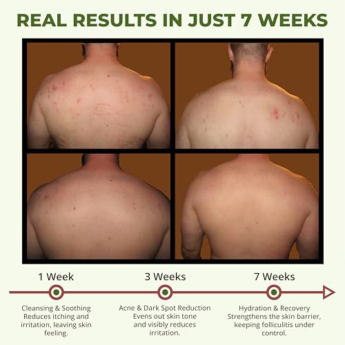 ABERA Folliculitis BHA Shower Gel, High-Performance Folliculitis Body Wash, Wild Bitter Melon Extract, Reduces Back Acne & Hyperkeratosis, 2 Boxes + Gift Grapefruit Hair Regrowth Shampoo for Hair Loss