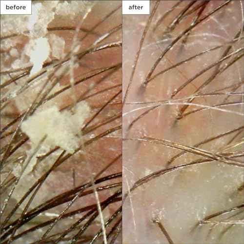 Briogeo Scalp Revival Charcoal + Coconut Oil Micro-Exfoliating Shampoo, Treatment for Dry & Itchy Scalp, Clarifying Shampoo for Build Up, Scalp Scrub for Oily Scalp, Vegan, Cruelty-Free