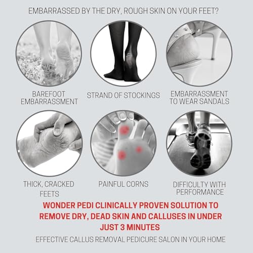 Callus Remover - Three Minutes Quick Fix- Foot File Rasp - Instant Foot Exfoliating Softener Peel Spray, Heels Callus Scrubber File - Home Spa Pedicure Treatment. Wonder Pedi