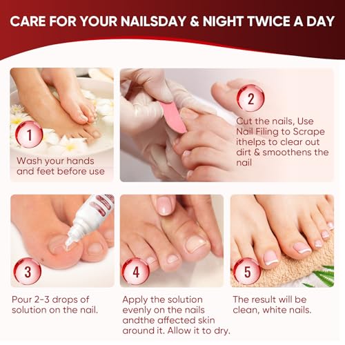 Toenail Treatment,Gentle Formula, Effectively Improves Nails for a More Beautiful Appearance