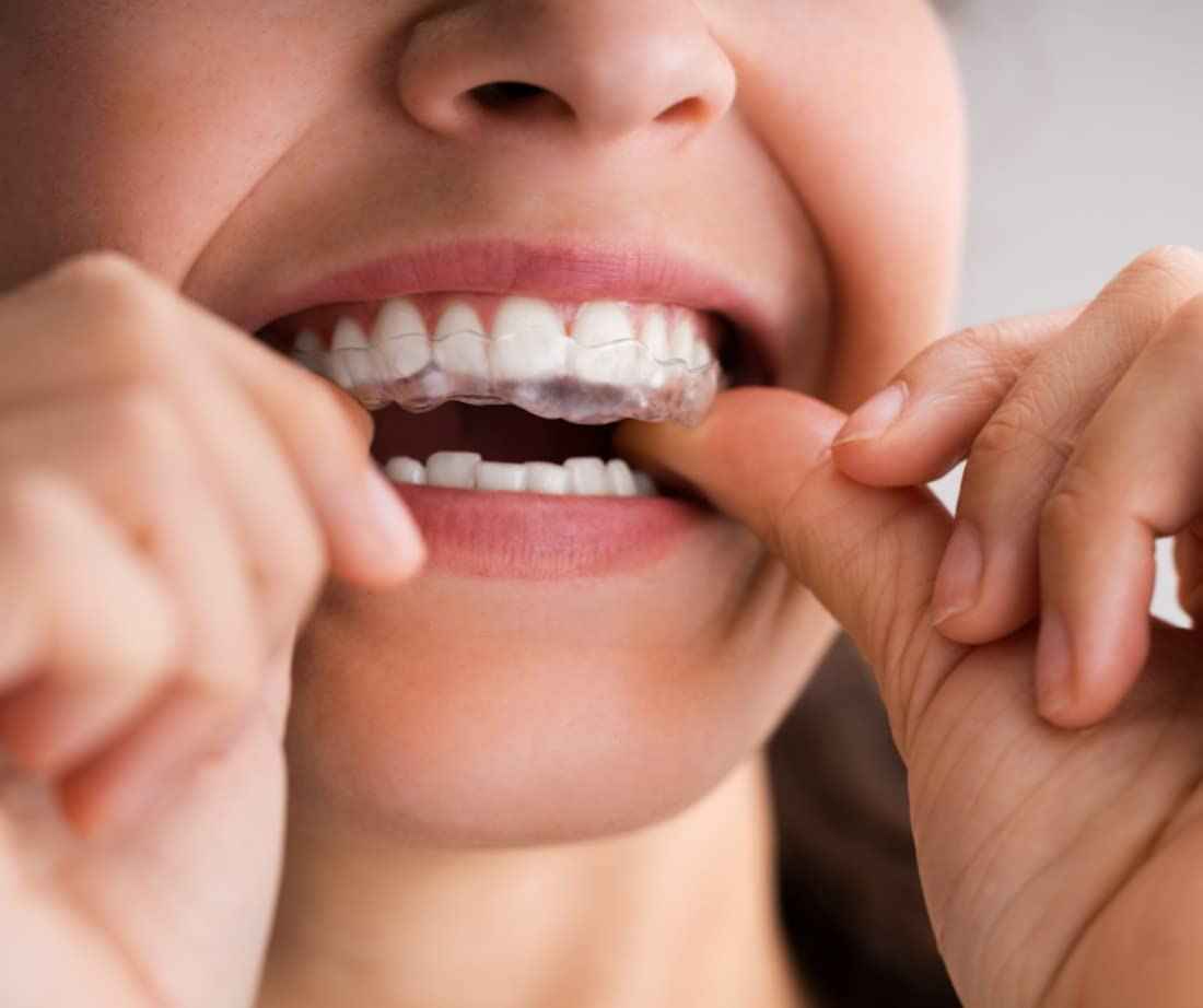 Impact Nightguards Custom Ultra Thin Day Guard 1mm -Lower