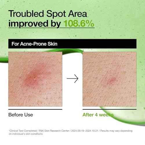 Anua Azelaic Acid 10 Hyaluron Redness Soothing Serum, Facial Serum for Sensitive skin, Hyaluronic Acid, Niacinamide, Spot Care, Natural Color, Vegan, Korean Skincare (30ml/ 1.01 fl oz.)