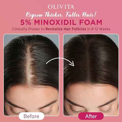 5% Minoxidil Foam for Women Hair Growth: Extra Strength Hair Regrowth Treatment ? Revitalize Hair Follicles & Regrow Thicker, Fuller Hair ? Hair Loss Solution-2pack