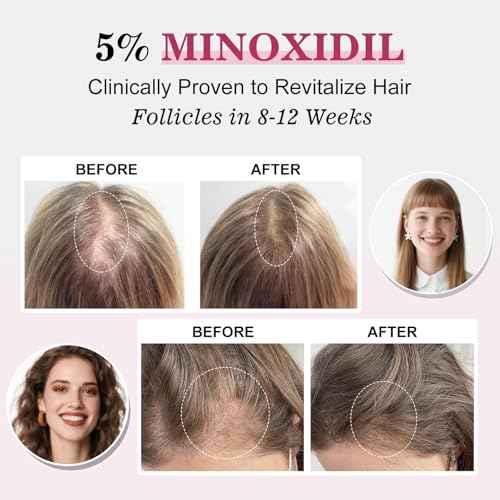 5% Minoxidil for Women Hair Regrowth Spray, hers hair regrowth treatment Infused with Biotin, Extra Strength Treatment to Combat Hair Loss and Thinning, 3 Bottles