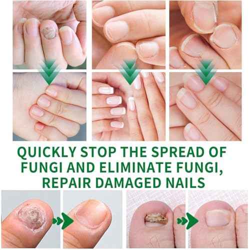 3PCS Ginger Nail Treatment, Nail Treatment, Ginger Cuticle Care Oil for Nails, Multi-Purpose Nail Oil